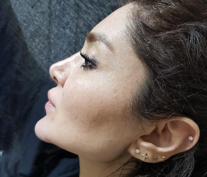 ژل بوتاکس خالبرداری فشیال زگیل تناسلی مطب زیبایی|خدمات آرایشگری و زیبایی|تبریز, |دیوار