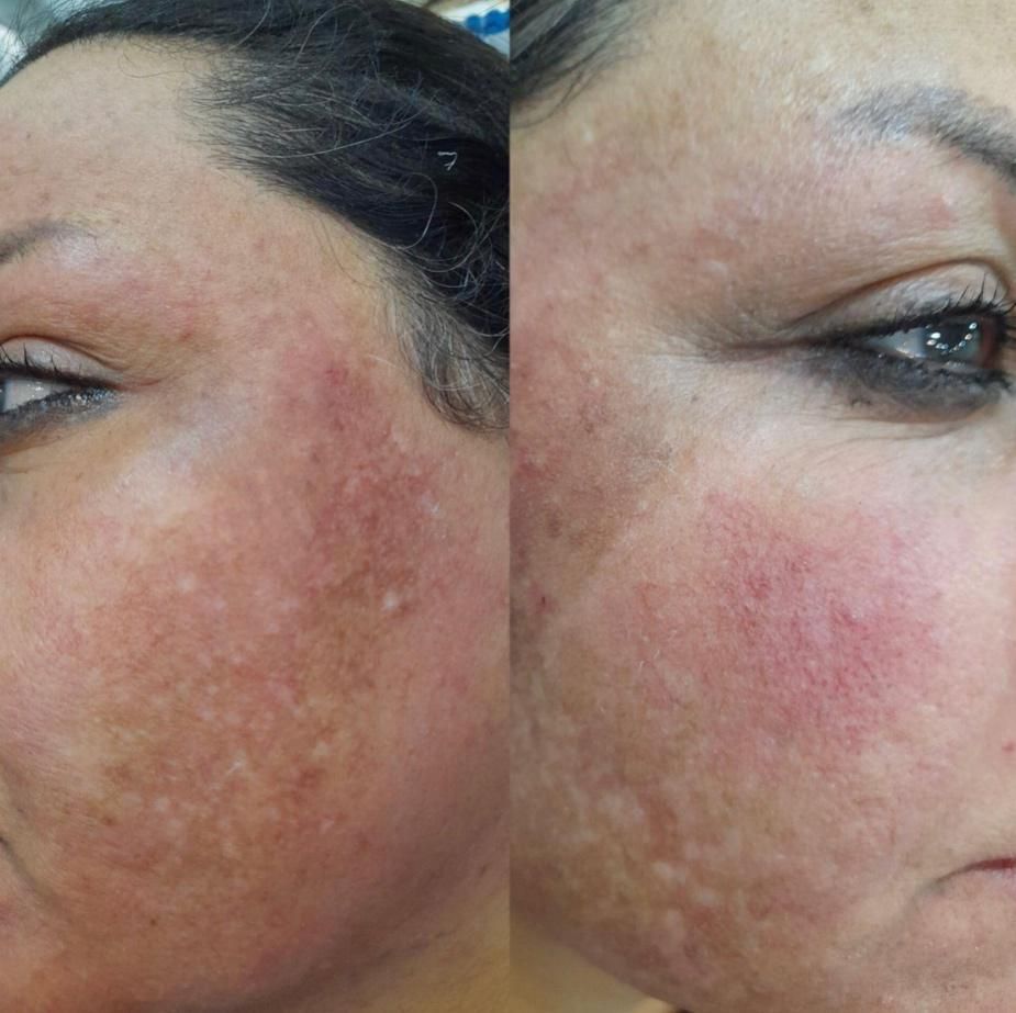 خدمات وآموزش پاکسازی پوست فیشیال فقط ویژه بانوان|خدمات آرایشگری و زیبایی|مشهد, طلاب|دیوار
