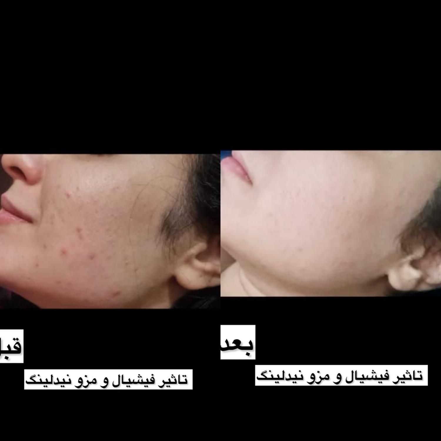 فقط برای 5نفر اول فیشیال ویژه 700|خدمات آرایشگری و زیبایی|شیراز, شهرک والفجر|دیوار