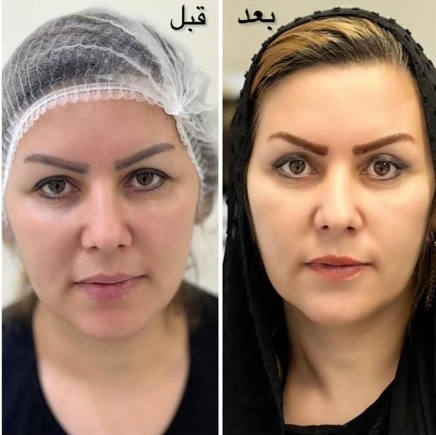 ژل بوتاکس خالبرداری فشیال زگیل تناسلی مطب زیبایی|خدمات آرایشگری و زیبایی|تبریز, |دیوار