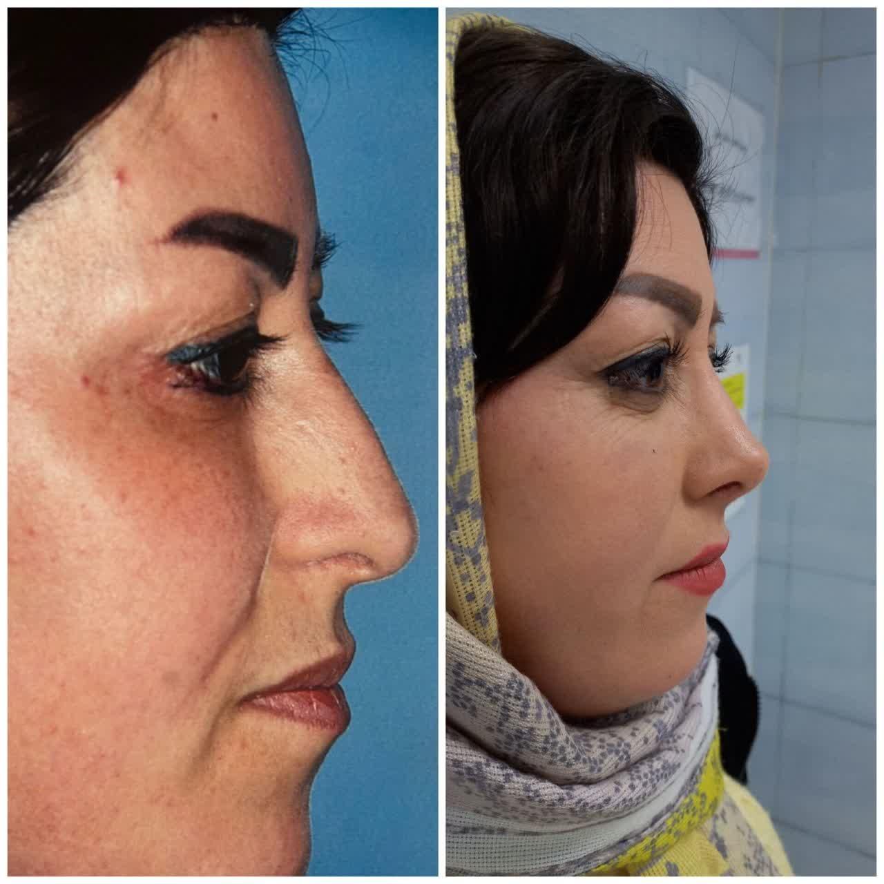 تخفیف۵۰درصدی عمل بینی ب مناسبت مبعث رسول|خدمات آرایشگری و زیبایی|تهران, شهرک غرب|دیوار