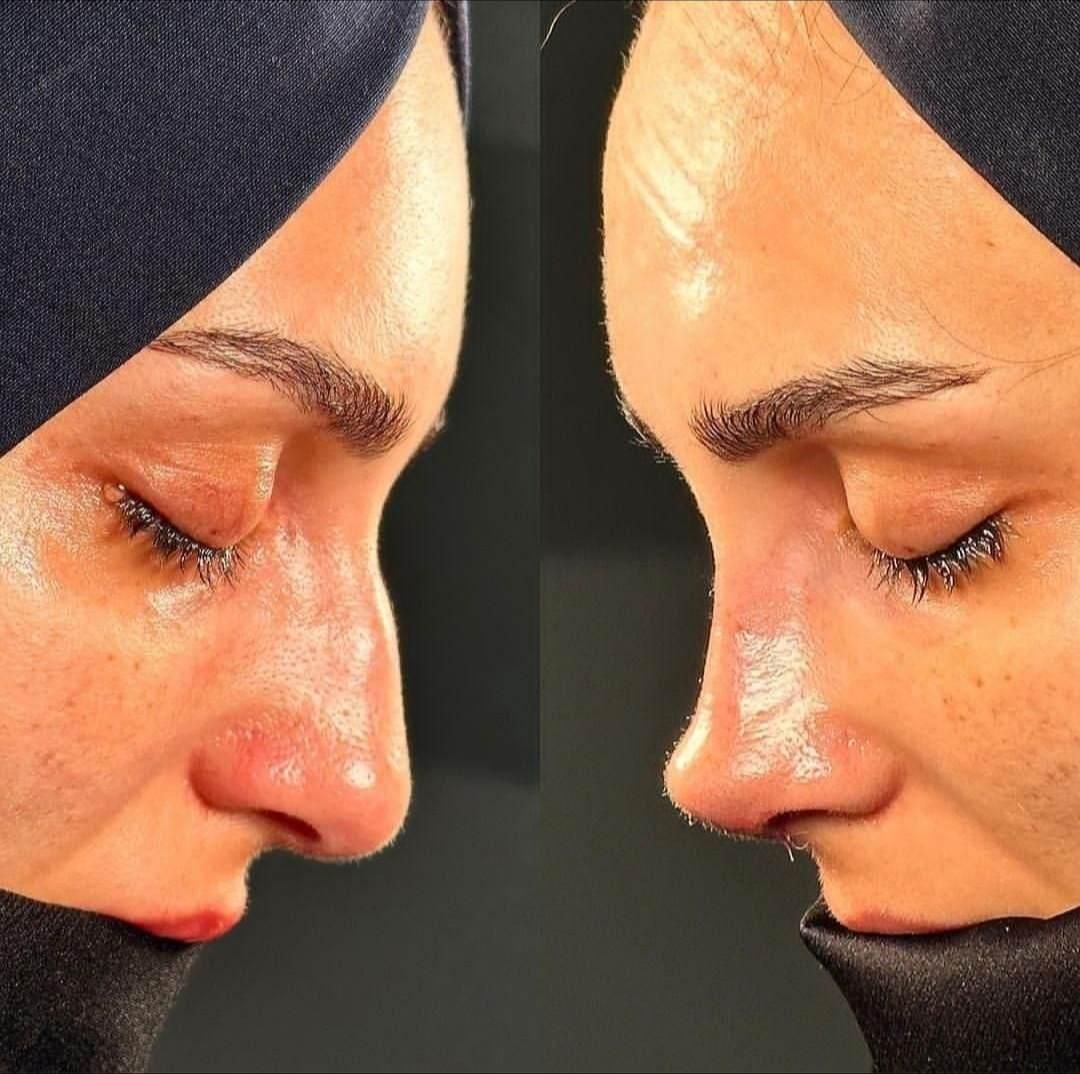 بلفاروپلاستی ،سانترال لب،لیفت ابرو،چربی صورت|خدمات آرایشگری و زیبایی|تهران, هروی|دیوار