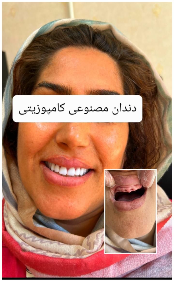 دندان مصنوعی پروتز ثابت، متحرک،کشیدن دندان|خدمات آرایشگری و زیبایی|کرمانشاه, |دیوار