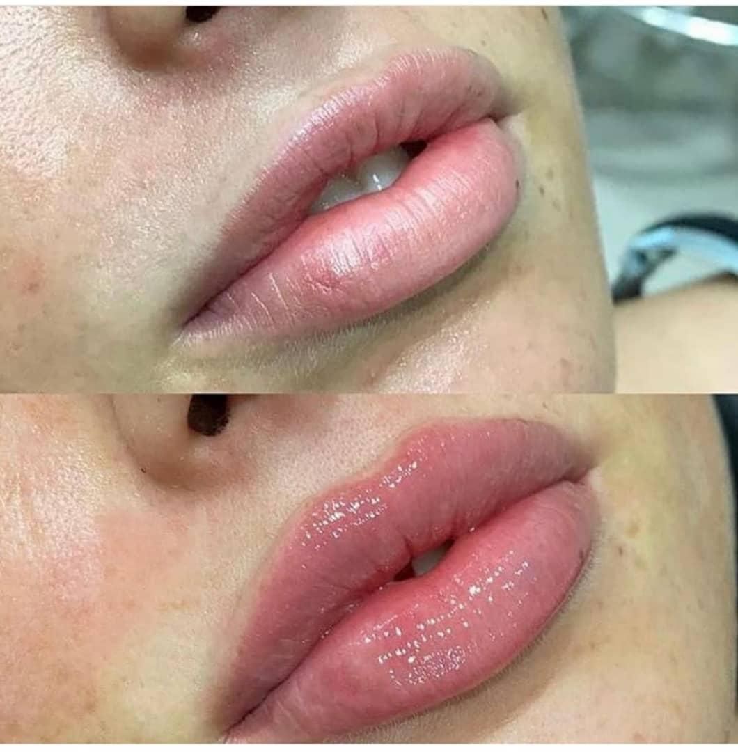 تزریق ژل و بوتاکس در تمام ایام حتی روزهای تعطیل|خدمات آرایشگری و زیبایی|فردیس, |دیوار