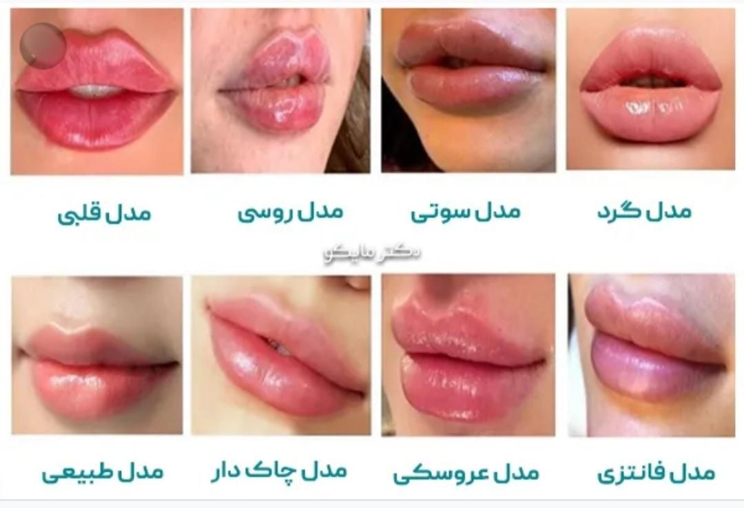 چربی بوتاکس ساکشن غبغب ژل مزو PRPتوسط پزشک مجرب|خدمات آرایشگری و زیبایی|زاهدان, |دیوار