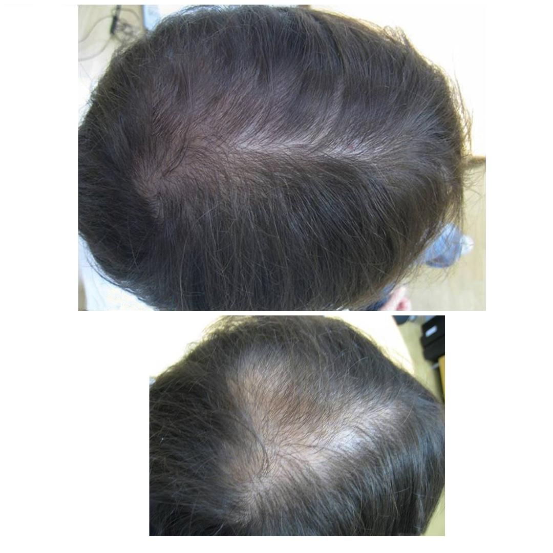 جلوگیری از ریزش مو با مزو|خدمات آرایشگری و زیبایی|شوش, |دیوار