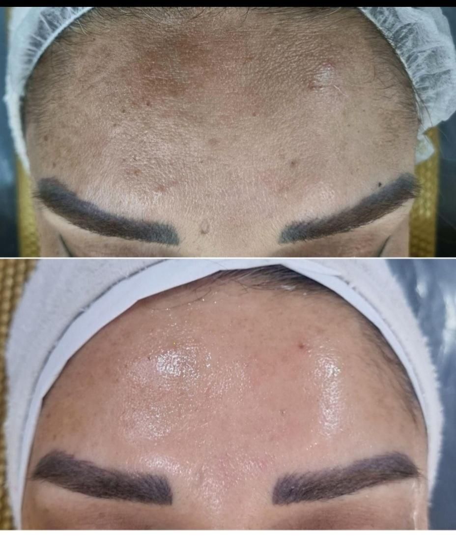 مدل پاکسازی رفع غبغب روشن کننده بیکینی و جراحی|خدمات آرایشگری و زیبایی|تهران, شهرک ولیعصر جنوبی|دیوار