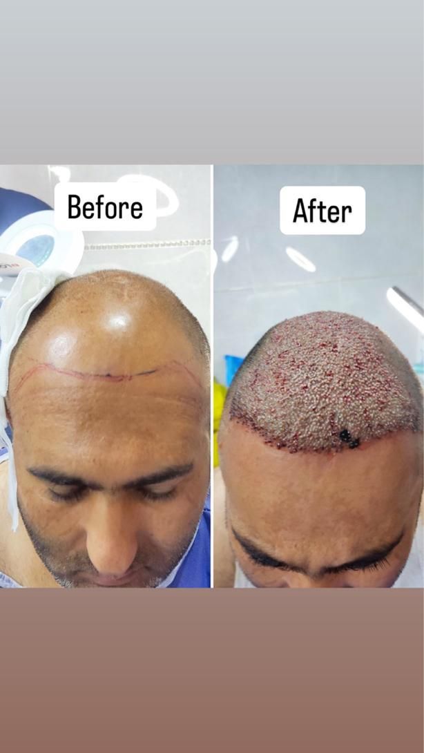 کاشت مو و ابرو و انجام بوتاکس و مزوتراپی و PRP|خدمات آرایشگری و زیبایی|قزوین, |دیوار