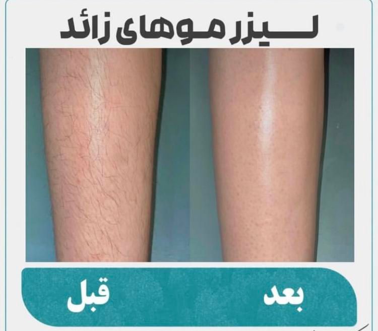 مطب خدمات لیزر مو شاتی گرویتی ونک|خدمات آرایشگری و زیبایی|تهران, ونک|دیوار