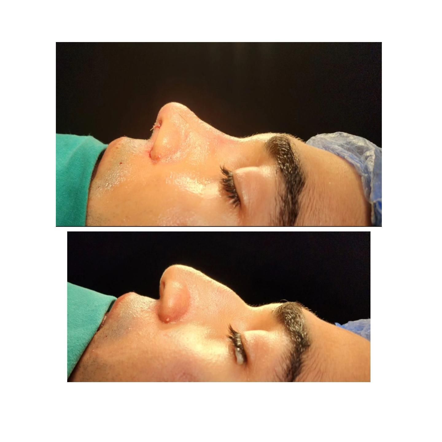 عمل زیبایی بینی(شوش)|خدمات آرایشگری و زیبایی|شوش, |دیوار