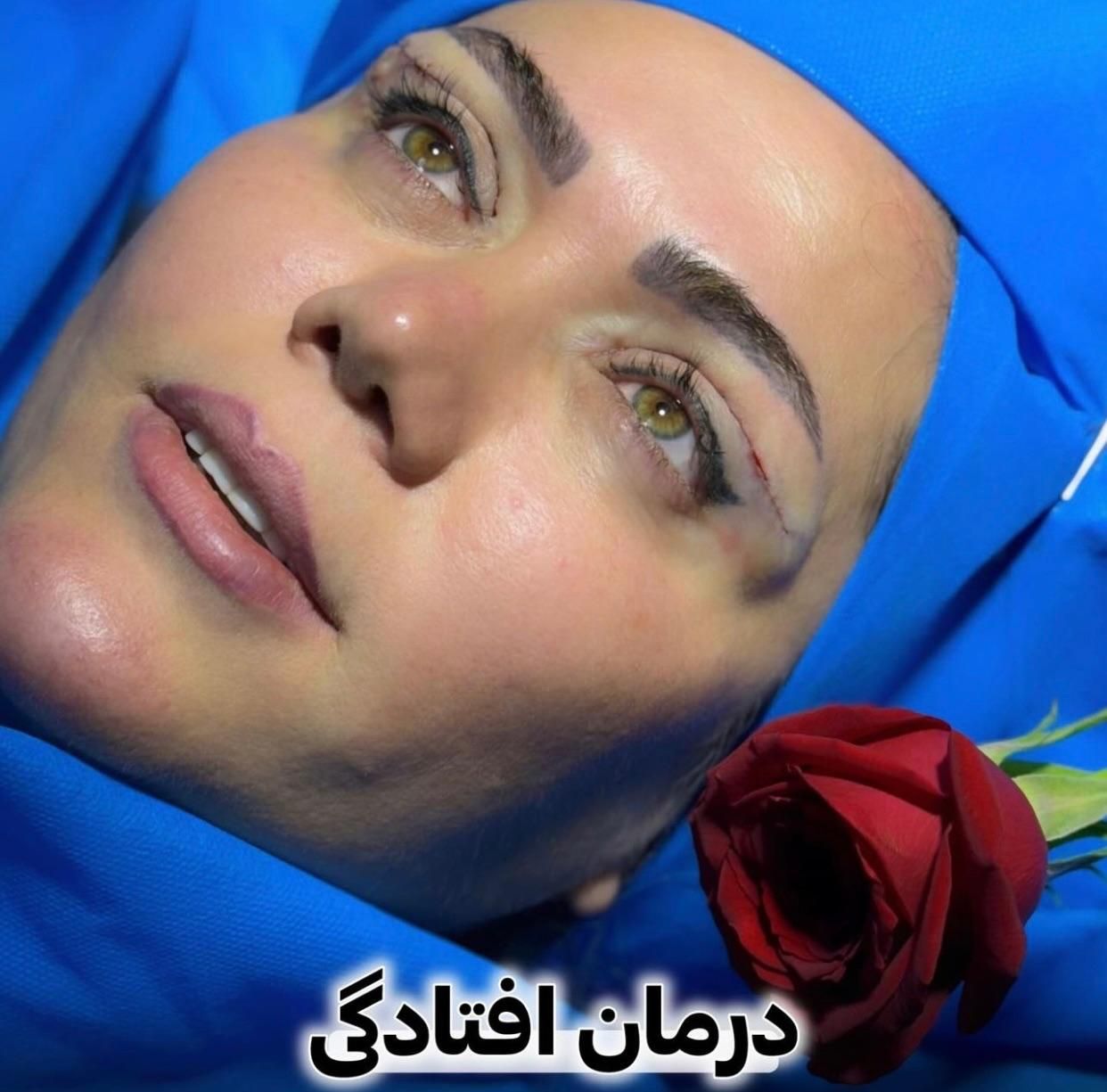 جراحی تخصصی بلفاروپلاستی با تکنیک جدید|خدمات آرایشگری و زیبایی|تهران, پاسداران|دیوار
