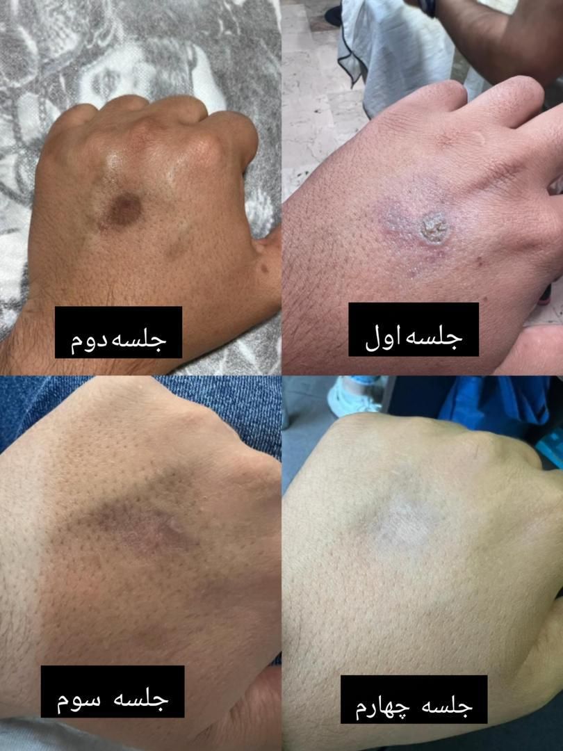 دستگاه Co2 فرکشنال ناب وی ۲۰۲۵|پزشکی|شیراز, ارم|دیوار