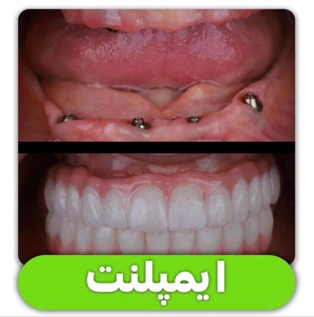 مرکز تخصصی ایمپلنت، مطب دندانپزشکی باقیمتی کم نظیر|خدمات آرایشگری و زیبایی|شیراز, قصرالدشت|دیوار