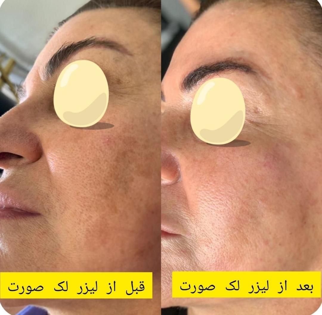 ریمو تتو و لک صورت با لیزر بدون زخم و نقاهت|خدمات آرایشگری و زیبایی|کرج, فاز ۲ مهرشهر|دیوار