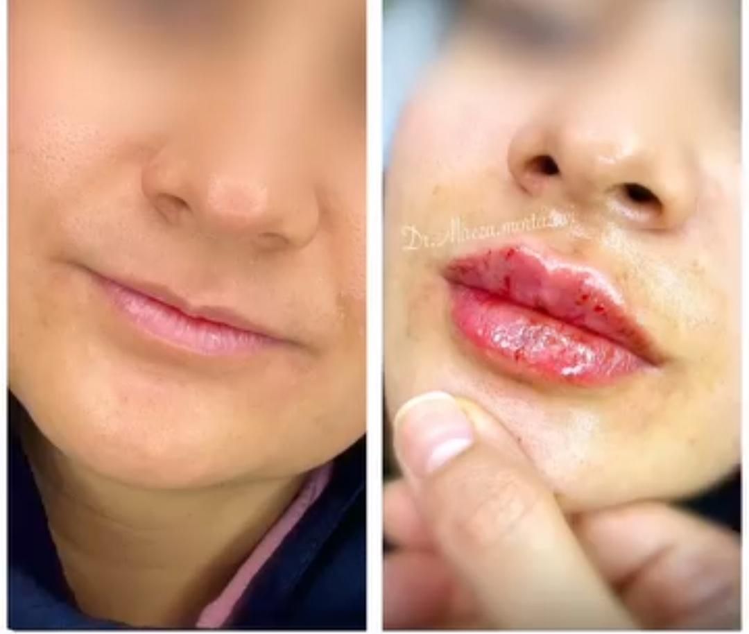 تزریق ژل و فیلر و بوتاکس و نخ لیفت و پی آرپی و ...|خدمات آرایشگری و زیبایی|همدان, |دیوار