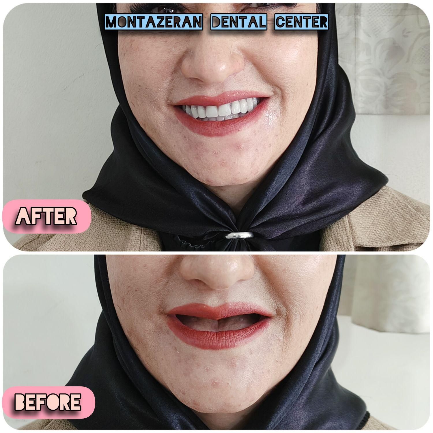 دندان مصنوعی/ دندانسازی ضمانتی/بیش ازنیم قرن تجربه|خدمات آرایشگری و زیبایی|مشهد, کوشش|دیوار