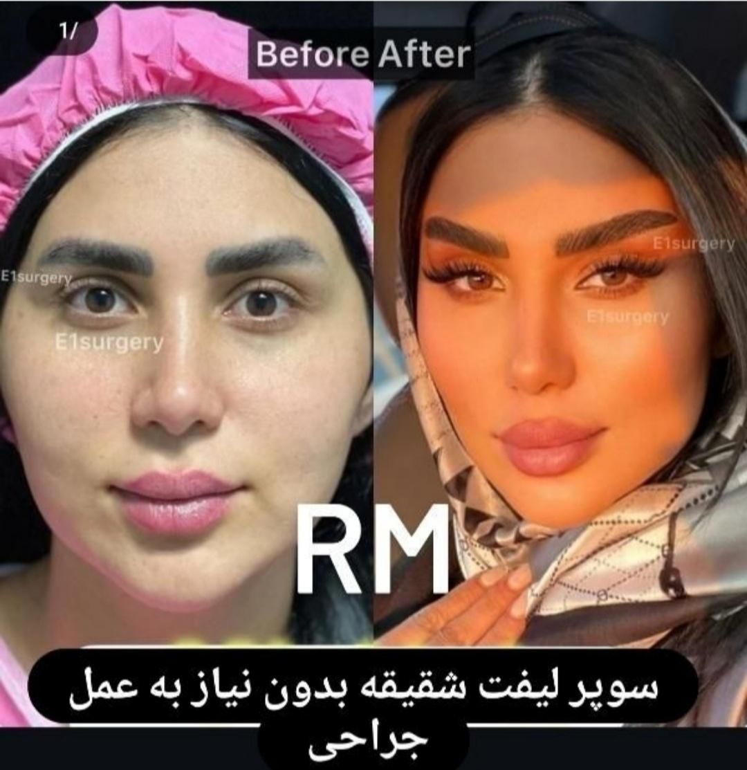 هایفو صورت،واژن.لیفت ابرو.لاغری ژل آنزیم مزو|خدمات آرایشگری و زیبایی|مشهد, آزادشهر|دیوار