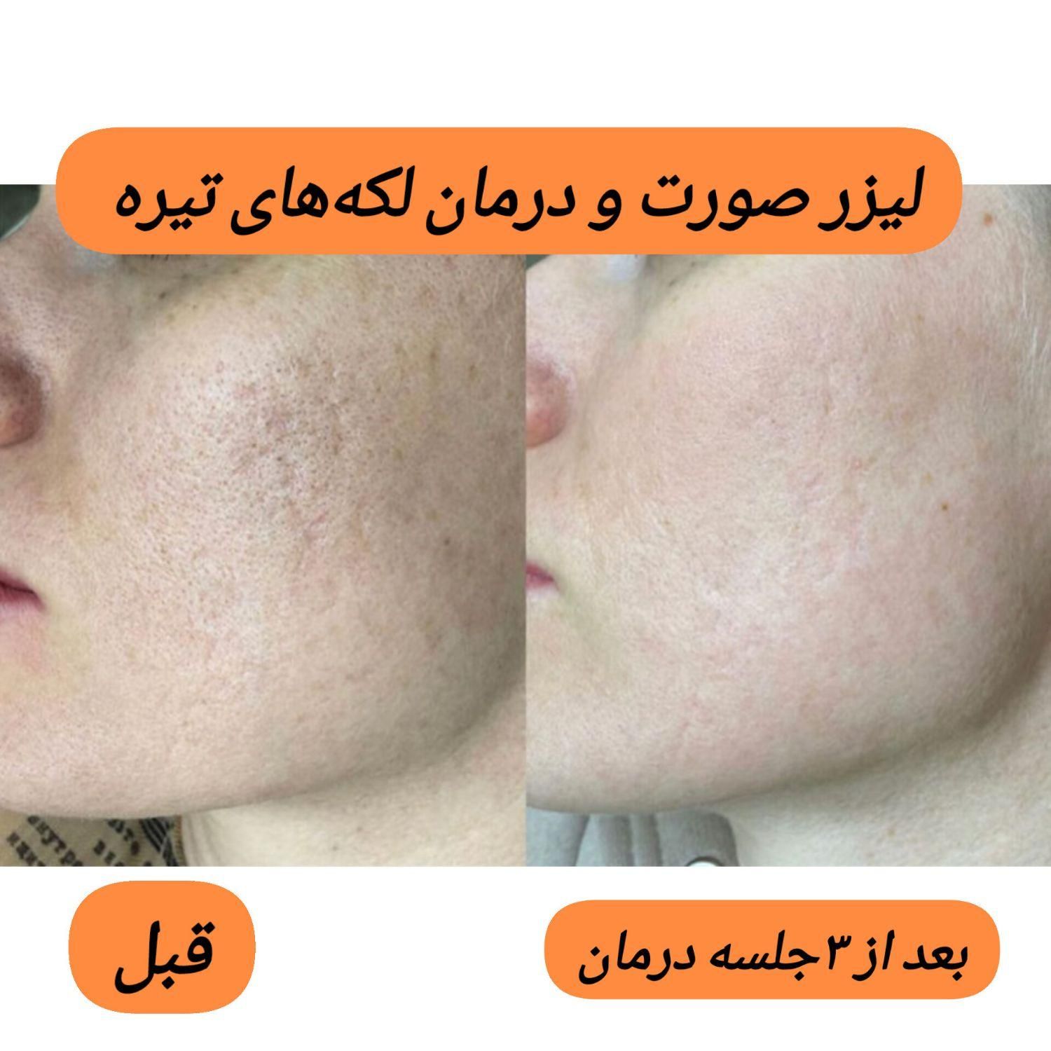 کیوسوئیچ، لیزر موهای زائد، هایفو، جوانسازی|خدمات آرایشگری و زیبایی|آبادان, |دیوار