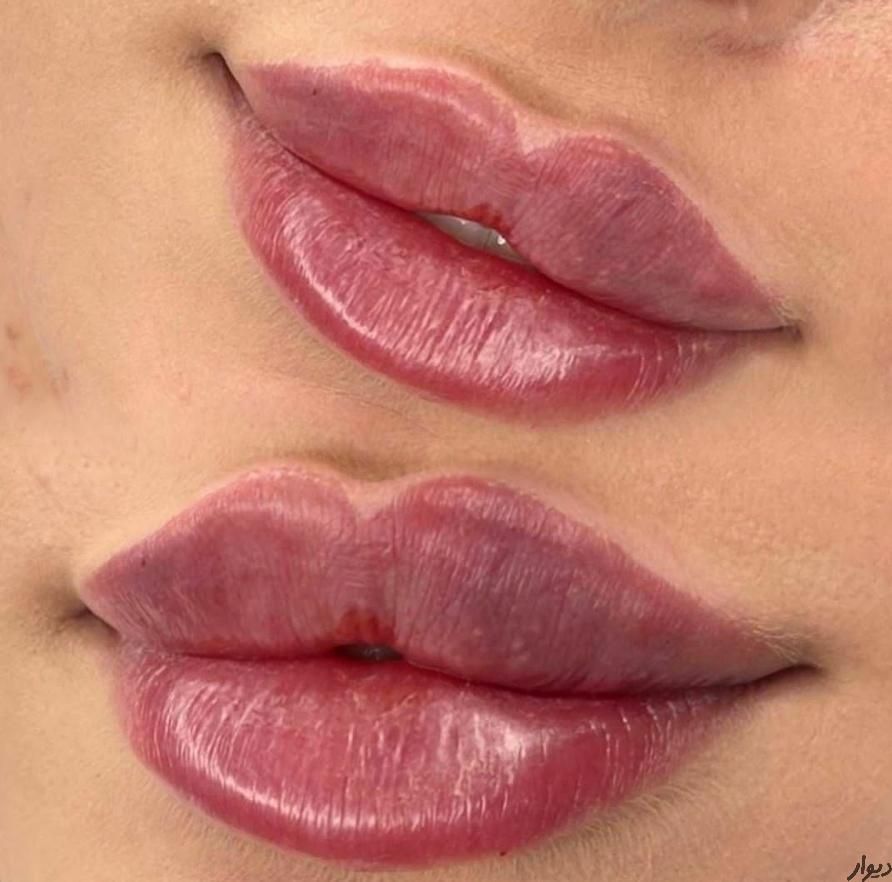ژل لب روسی/بوتاکس/فیلر زیر چشم/زاویه فک لیزر بدن|خدمات آرایشگری و زیبایی|تهران, ستارخان|دیوار