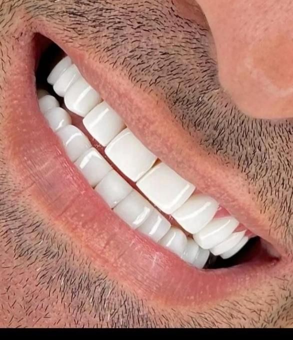 کامپوزیت دندان/ لمینت/ عصب کشی/ زیبایی|خدمات آرایشگری و زیبایی|تهران, تهرانپارس غربی|دیوار