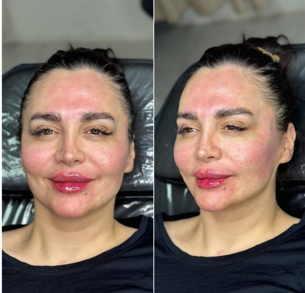 لیفت صورت با نخ. ژل.بوتاکس.مزوژل. درکلینیک|خدمات آرایشگری و زیبایی|کرمانشاه, |دیوار
