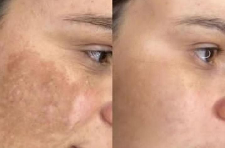 پاکسازی پوست،مطب سوپر فشیال تخصصی اقایان و بانوان|خدمات آرایشگری و زیبایی|تهران, نارمک|دیوار