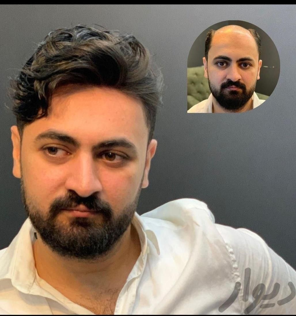 پروتز مو ، چسب پروتز ، ترمیم و تعویض چسب|خدمات آرایشگری و زیبایی|تبریز, |دیوار