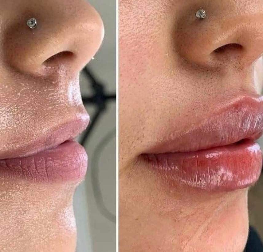 بوتاکس مصپورت فقط۴۹۰ کلینیک زیبایی دکتر فرشیدکریمی|خدمات آرایشگری و زیبایی|کرمانشاه, |دیوار