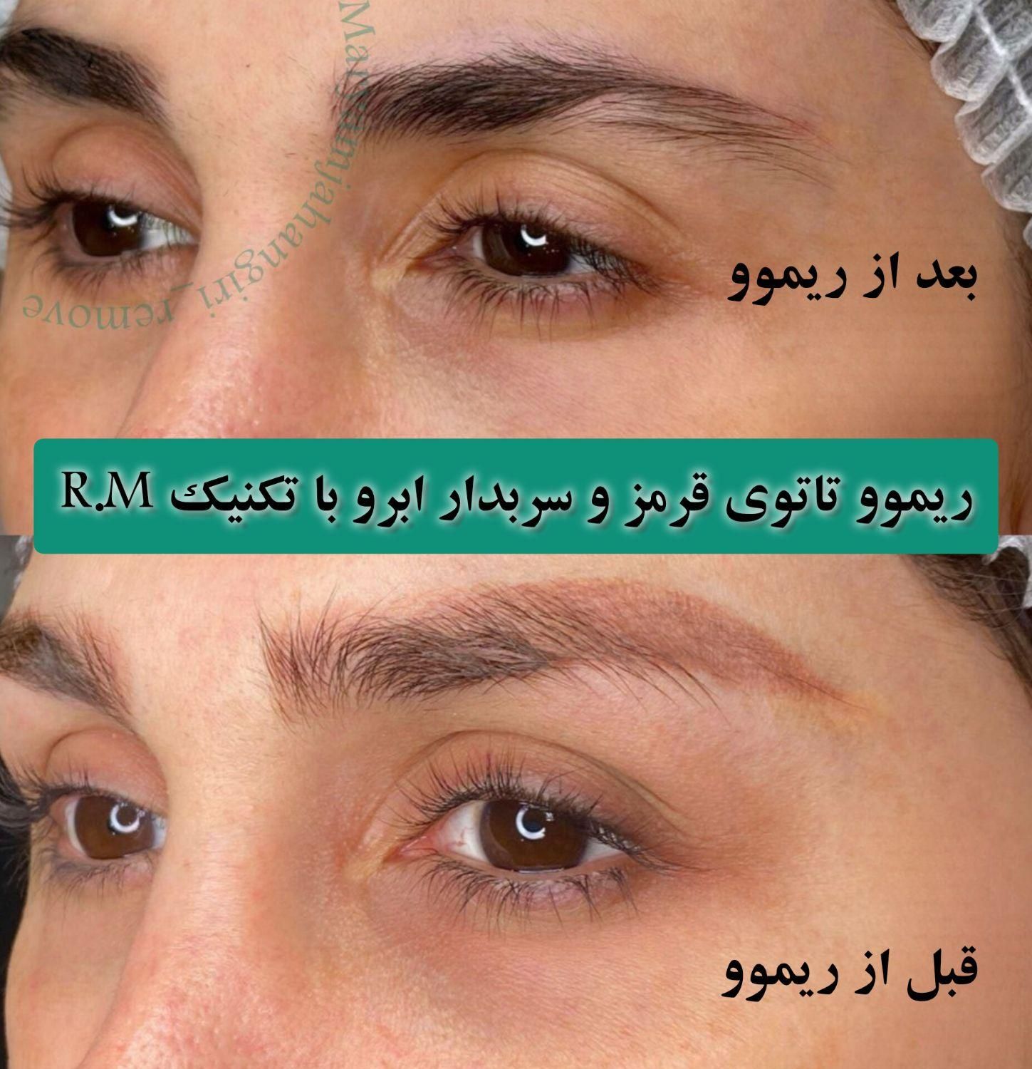 تخفیف ریموو تتو ابرو، خط چشم و لب در مرکز پوست غرب|خدمات آرایشگری و زیبایی|تهران, باغ فیض|دیوار