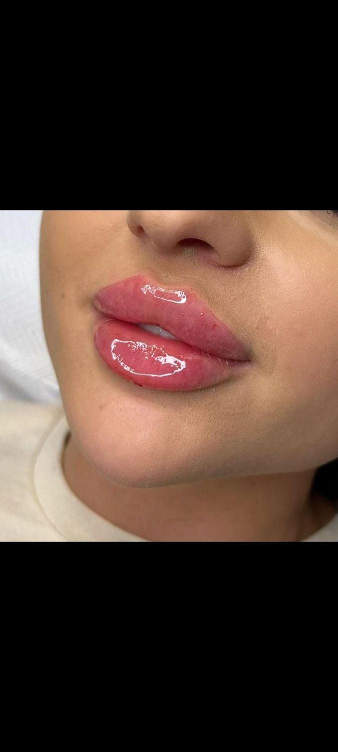 تزریق ژل بوتاکس،هایفو مزوتراپی توسط پزشک|خدمات آرایشگری و زیبایی|کرج, گوهردشت|دیوار