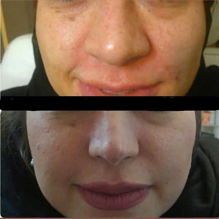 آنزیم ژل لب.بینی.غعبغب. ژل های گلوله شده چربی سوز|خدمات آرایشگری و زیبایی|خرم‌آباد, |دیوار