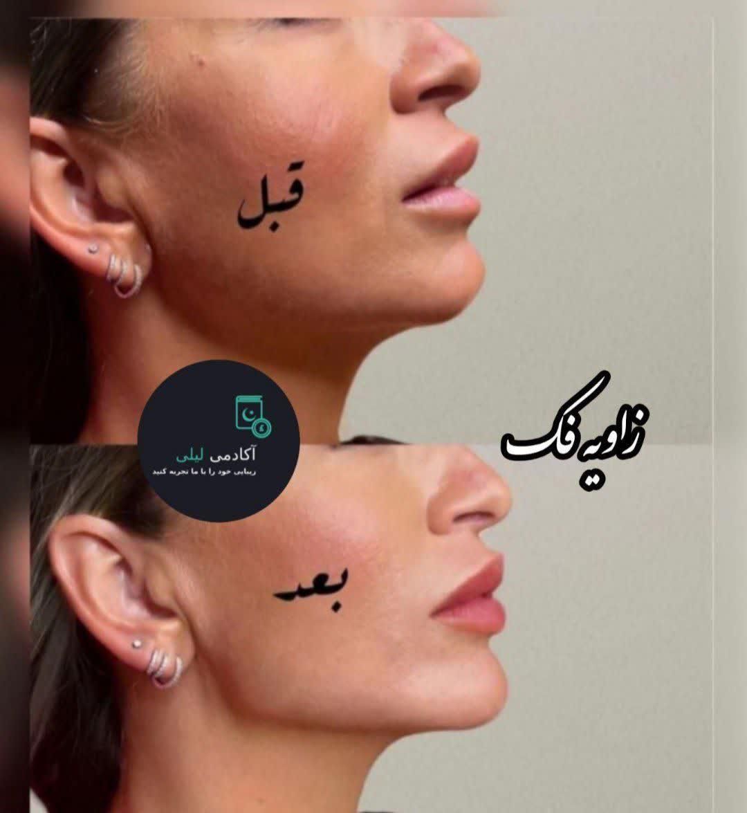 بوتاکس ژل لب زاویه فک.گونه .چانه. پرکردن صورت لاغر|خدمات آرایشگری و زیبایی|قم, زنبیل آباد|دیوار