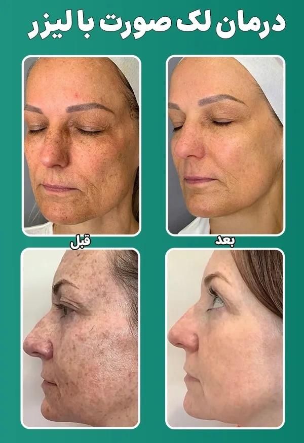 لیزر مو حتی کرکی ، لیزر انواع تتو ،لیزر سفیدکننده|خدمات آرایشگری و زیبایی|ایلام, |دیوار
