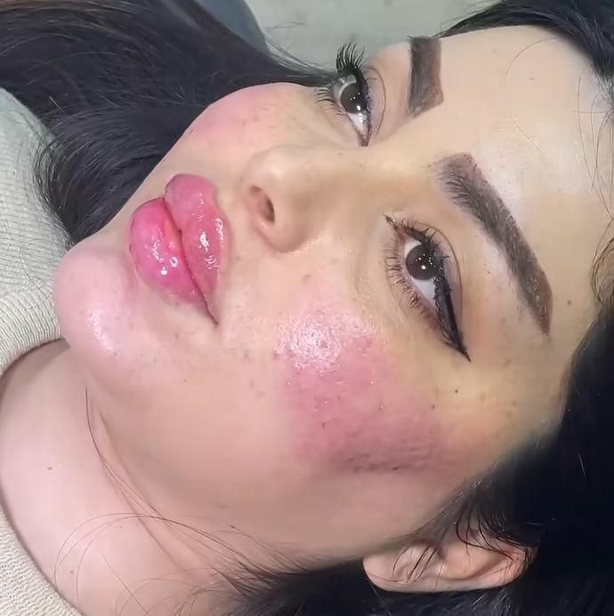 ژل بوتاکس کانتورینگ لیفت بانخ|خدمات آرایشگری و زیبایی|تهران, صادقیه|دیوار