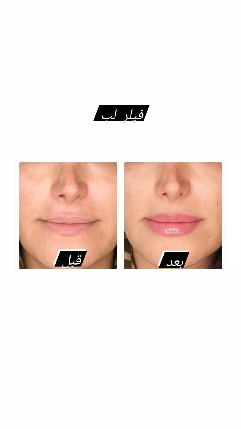 ژل بوتاکس مزوتراپی مزوژل سابسیژن/آموزش/در منزل|خدمات آرایشگری و زیبایی|تهران, تهرانپارس غربی|دیوار