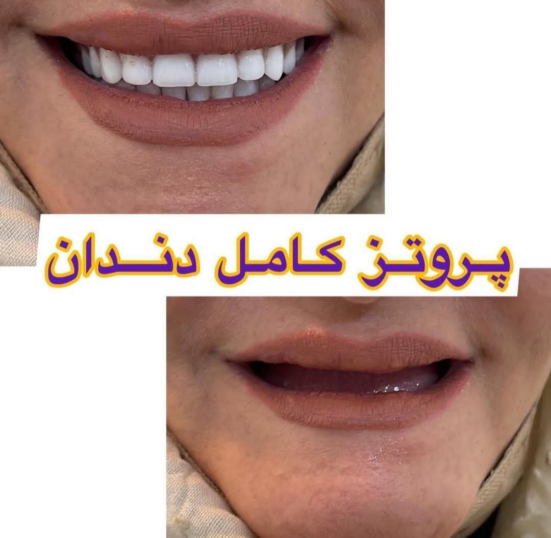 دندان مصنوعی/ دست دندان/ ژله ای/ چکی|خدمات آرایشگری و زیبایی|کرج, چهارصد دستگاه|دیوار