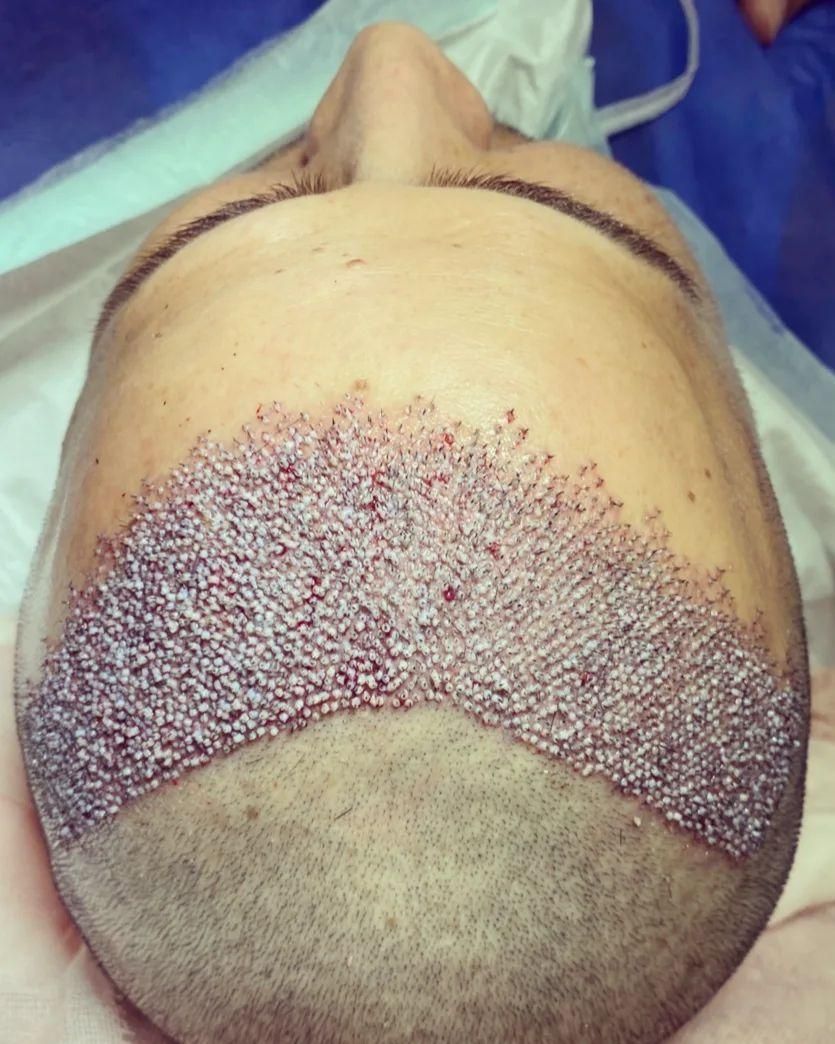 کاشت موی طبیعی|خدمات آرایشگری و زیبایی|اهواز, زیتون کارمندی|دیوار