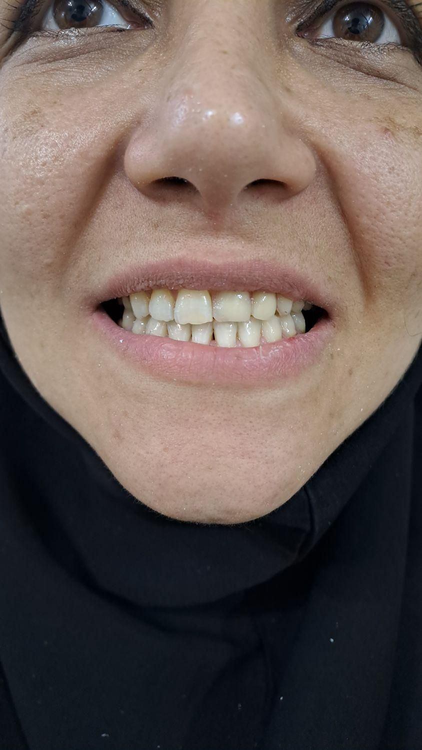 دندانپزشکی .دست دندان  هر فک ۴ میلیون تحویل ۳ روزه|خدمات آرایشگری و زیبایی|اسلام‌شهر, |دیوار