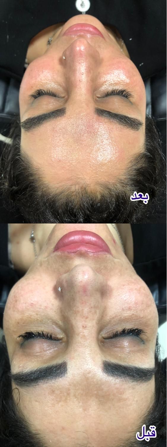 پاکسازی رایگان پوست مطهری|خدمات آرایشگری و زیبایی|رشت, خمیران زاهدان|دیوار