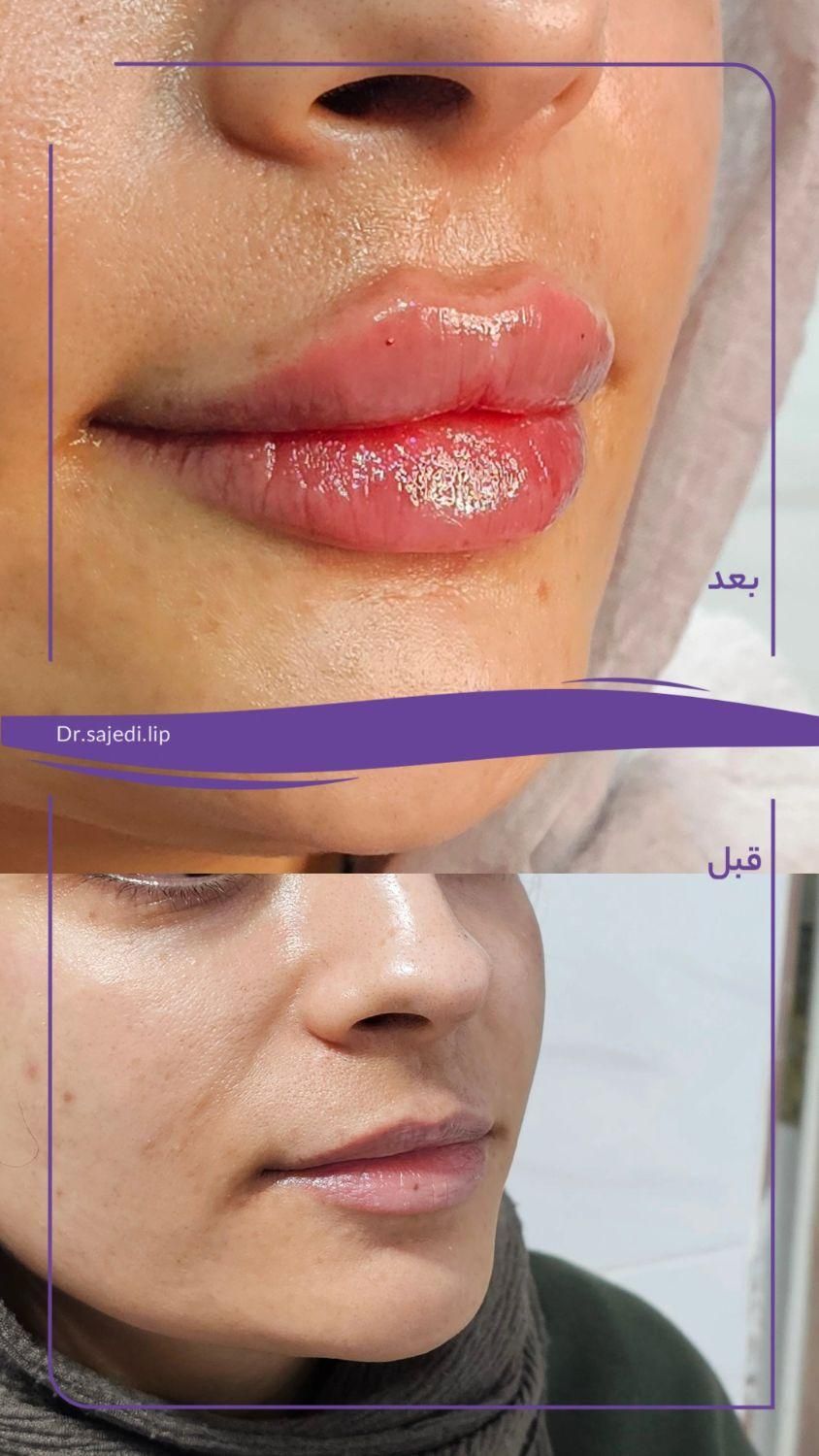 لب / ژل لب / روسی و طبیعی|خدمات آرایشگری و زیبایی|شوش, |دیوار