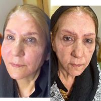 لیفت طبیعی کامل صورت ام دی کد کانتور صورت|خدمات آرایشگری و زیبایی|تهران, میرداماد|دیوار