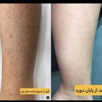 جشنواره لیزر موی زائد تضمینی/۱۴۹ جلسه اولی ها|خدمات آرایشگری و زیبایی|اصفهان, کوی امیریه|دیوار