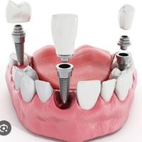 ایمپلنت دندان آلمانی ۷/۵۰۰|خدمات آرایشگری و زیبایی|تهران, سعادت‌آباد|دیوار