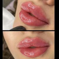 تزریق ژل لب و گونه و چانه و..(جشنواره)درمطب|خدمات آرایشگری و زیبایی|اصفهان, ملک‌شهر|دیوار