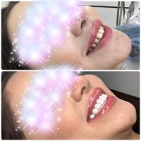 کامپوزیت زیبایی دندان|خدمات آرایشگری و زیبایی|تهران, سعادت‌آباد|دیوار