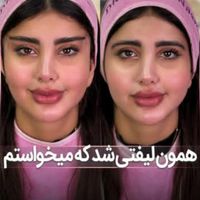 ژل بوتاکس کانتورینگ لیفت بانخ|خدمات آرایشگری و زیبایی|تهران, صادقیه|دیوار