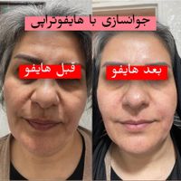 هایفو7D،هایفوتراپی،آراف فرکشنال،اموزش،اجاره|خدمات آرایشگری و زیبایی|تهران, سعادت‌آباد|دیوار