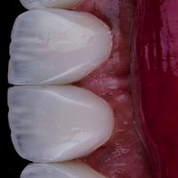 کامپوزیت دندانپزشکی ارتودنسی|خدمات آرایشگری و زیبایی|بندرعباس, |دیوار