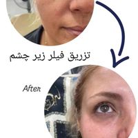 تزریق ژل مدل زاویه،گونه،چونه،لب|خدمات آرایشگری و زیبایی|تهران, امامزاده حسن(ع)|دیوار