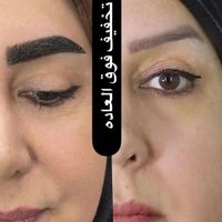 کاشت ابرو مو شقیقه ریش مزو تراپی نچرال طبیعی|خدمات آرایشگری و زیبایی|اصفهان, خانه اصفهان|دیوار